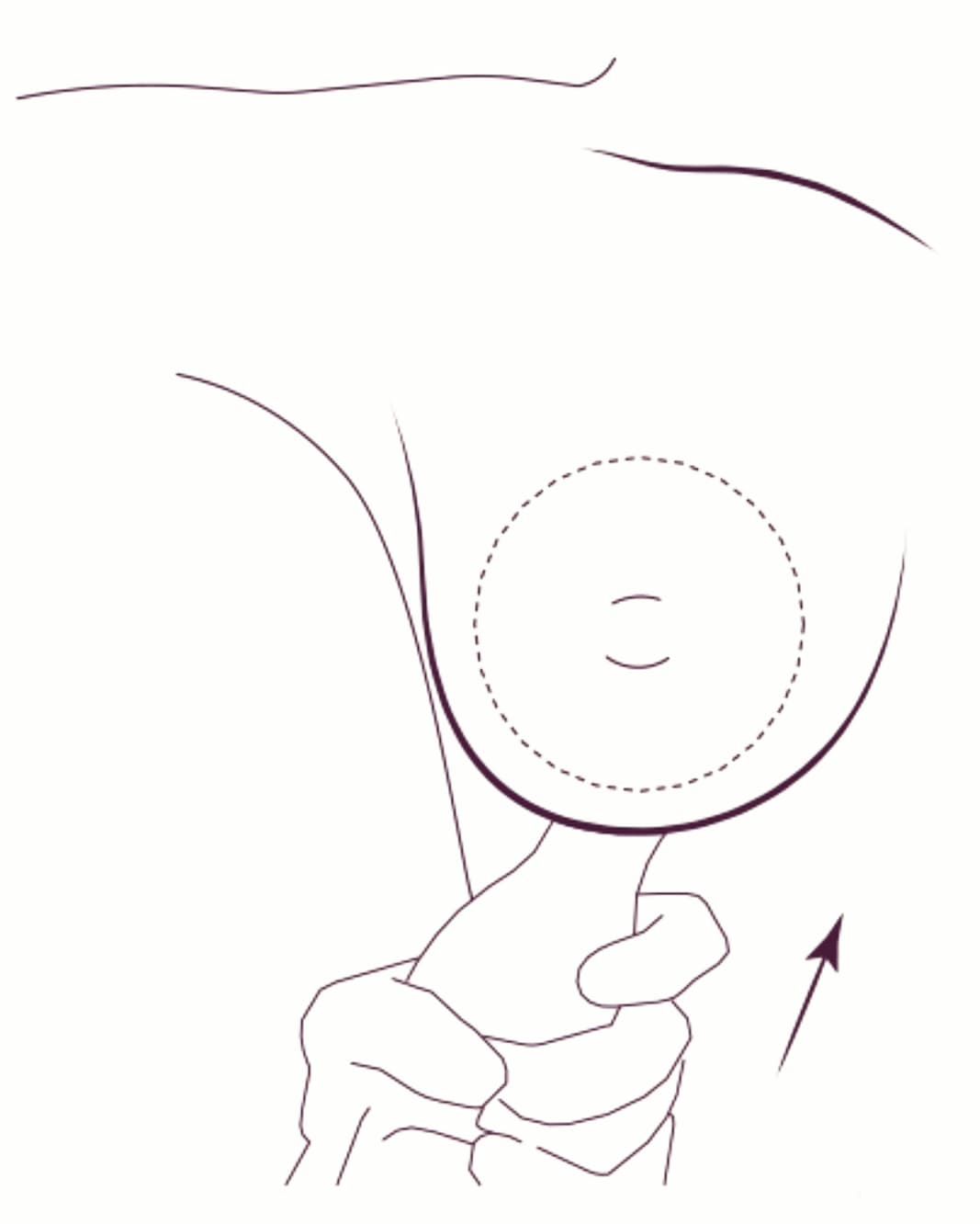 Az implantátumot egy steril „csúszda” (insertion sleeve) segítségével juttatjuk be.