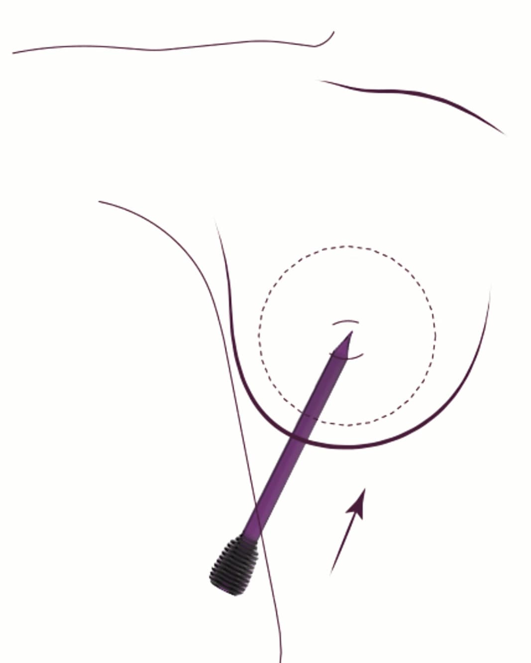 Szövetszétválasztás speciális szabadalmaztatott eszközök segítségével